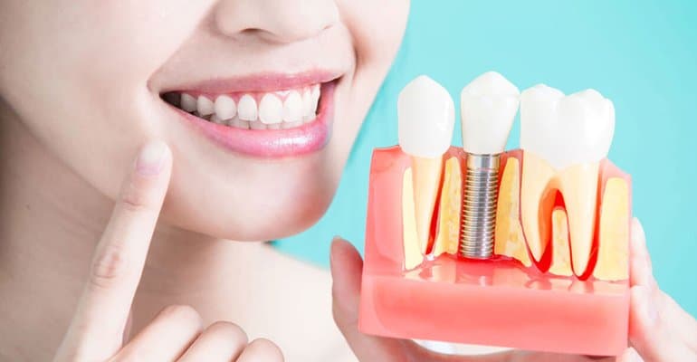 Dental implant procedure, Kitchener