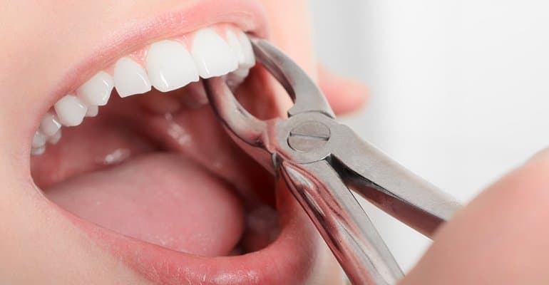Tooth extraction service at Benton Dental Clinic