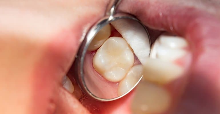 White composite dental filling at Benton Dental Clinic